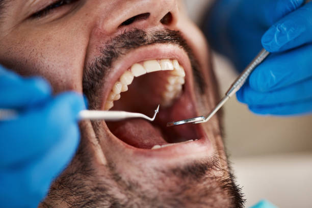 Best Emergency Tooth Extraction in Roslyn, PA